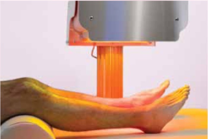Collagentex RX-1 treating the legs