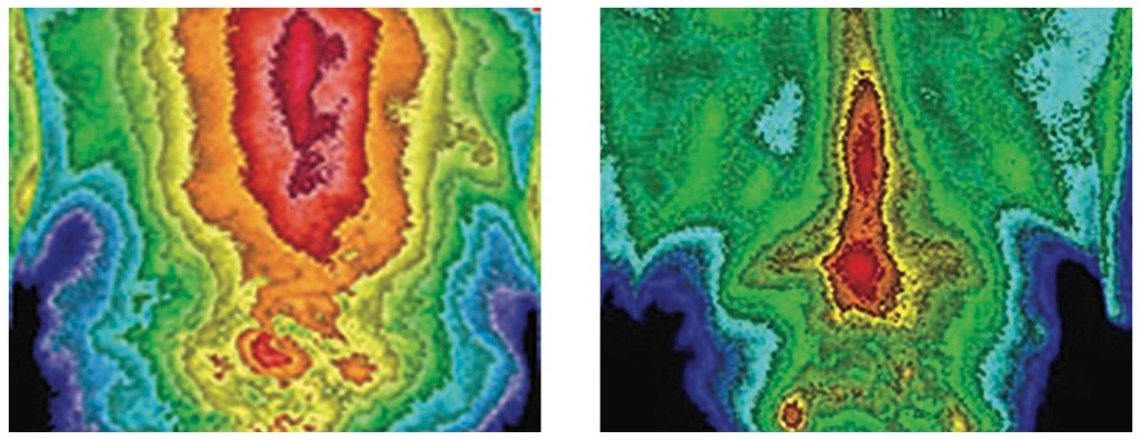 Thermal images of the lower back before and after a series of Firefly treatments