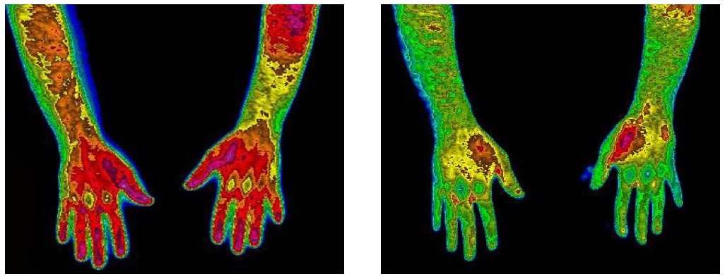 Thermal images of a severe wrist injury before and after Firefly therapy